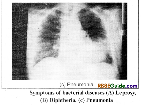 RBSE Class 12 Biology Notes Chapter 40 Important and Common Human Diseases 22